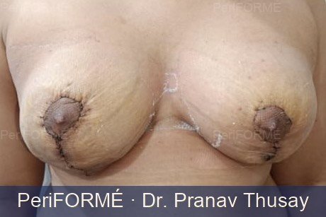 Breast Asymmetry Before
