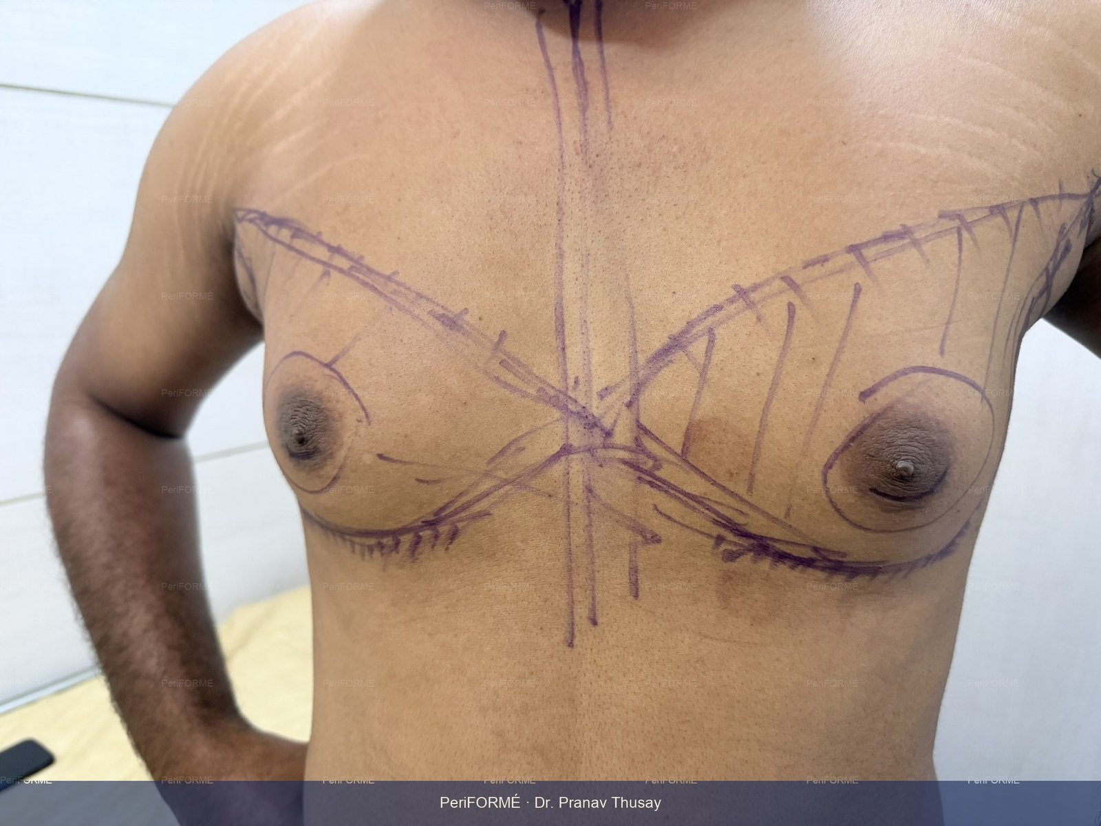 Gynaecomastia surgery -Scarless liposuction — Before
