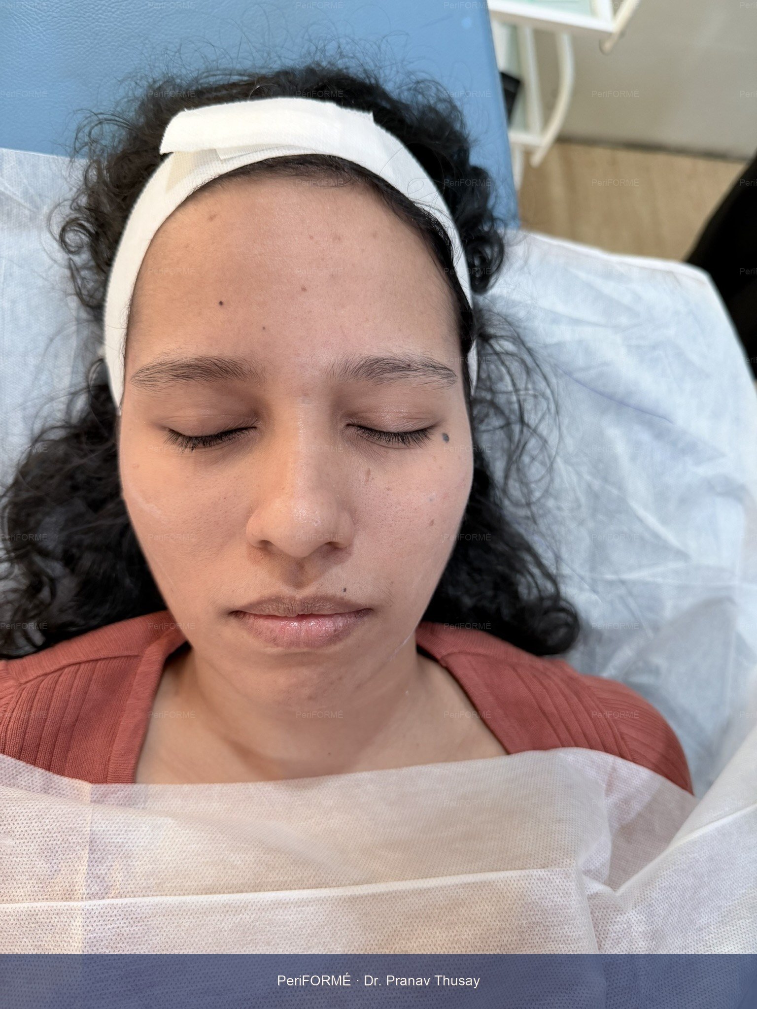 Nonsurgical facelift and Facial rejuvenation — After