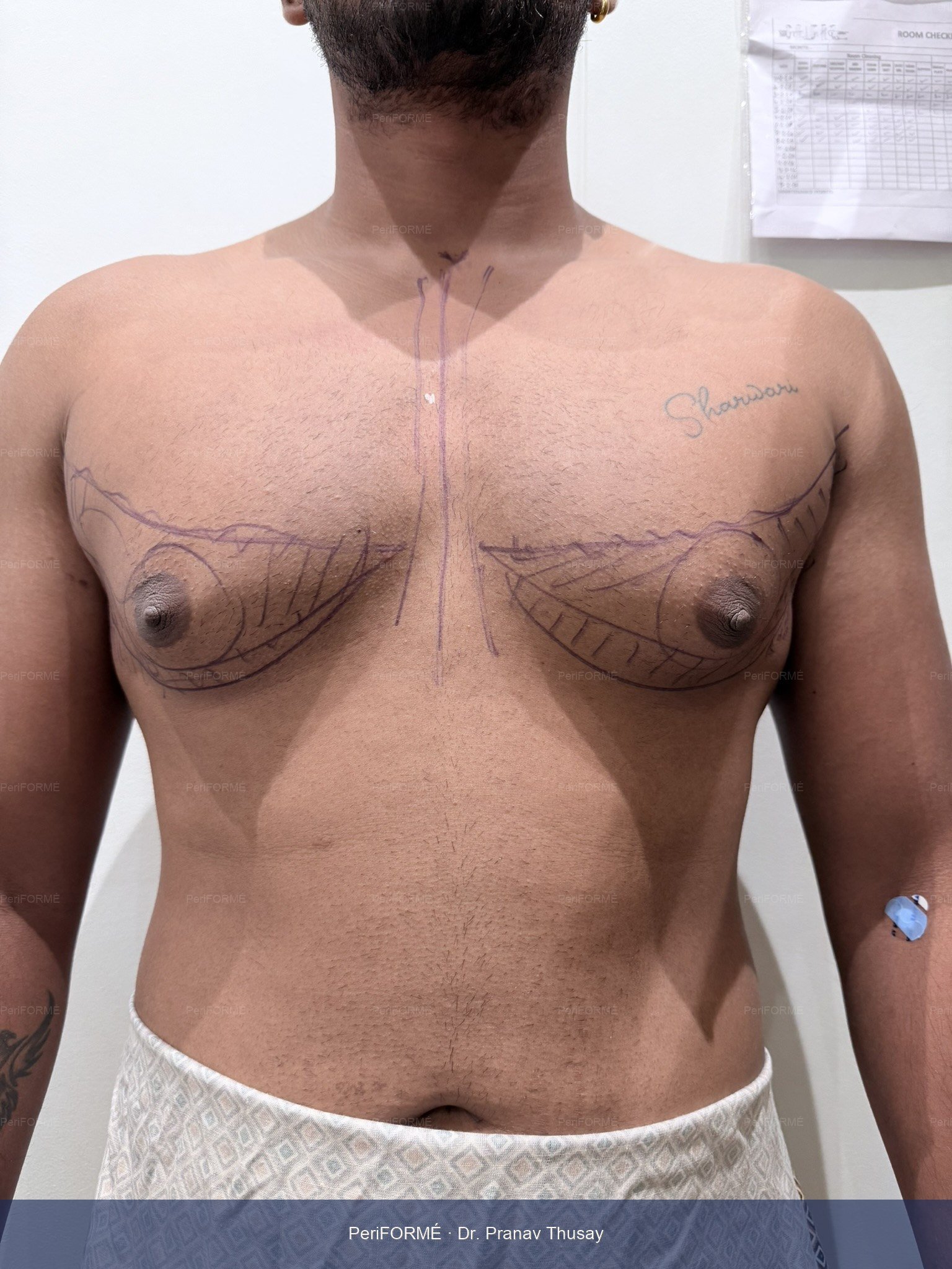 Scarless gynaecomastia surgery — Before