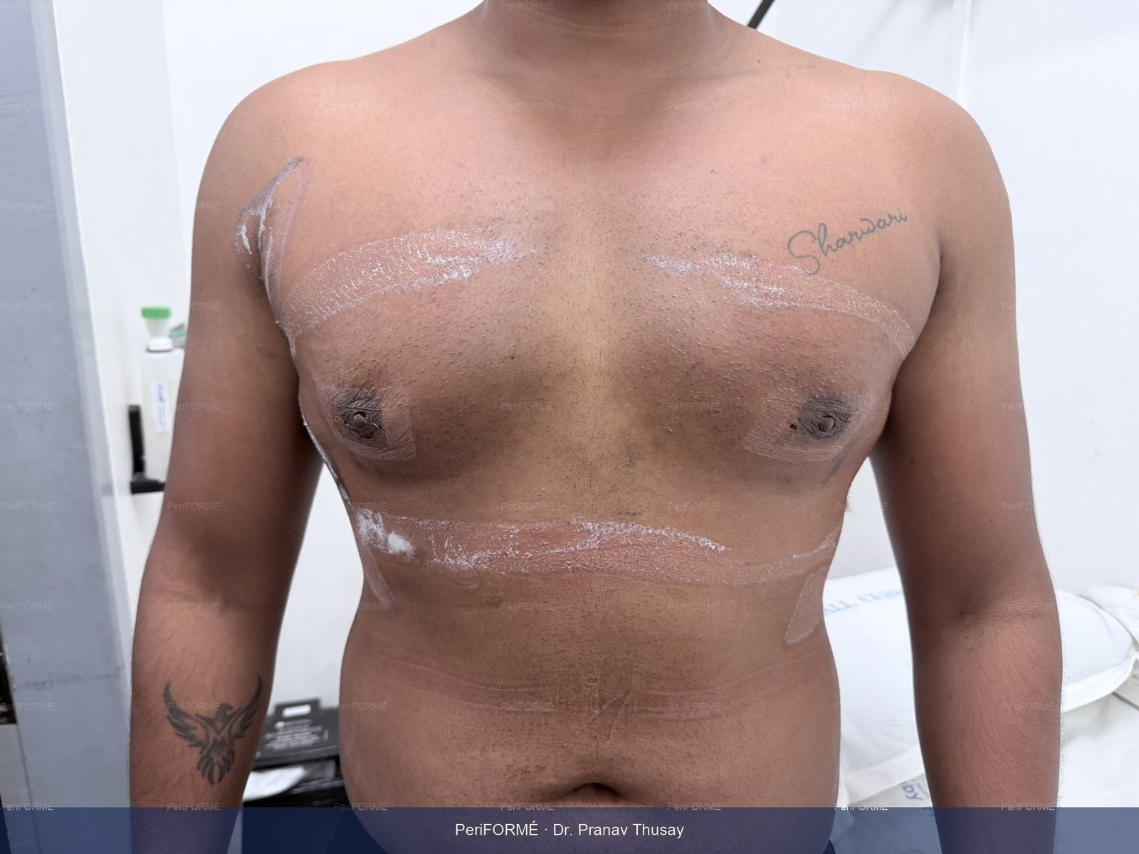 Scarless gynaecomastia surgery (Male breast reduction) — After